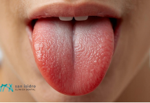 ¿Y tú… cómo colocas la lengua? La importancia del frenillo lingual en niños frenillo lingual